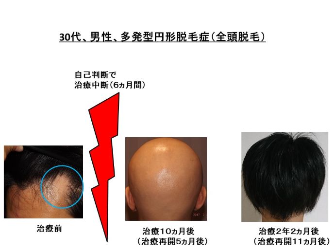 円形脱毛症　病院